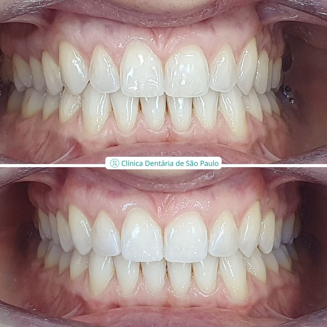 Ortodontia & Dentisteria - Caso 2